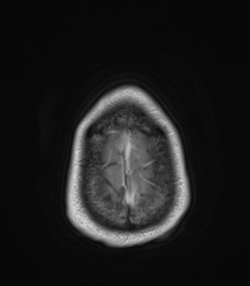 Anaplastic astrocytoma IDH wild-type (Radiopaedia 49984-55273 Axial T1 C+ 53).png