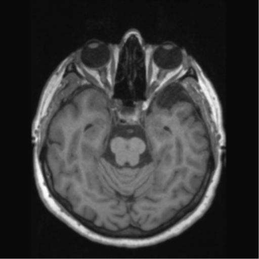 Anaplastic astrocytoma IDH wild-type (pseudoprogression) (Radiopaedia 42209-45276 Axial T1 59).png