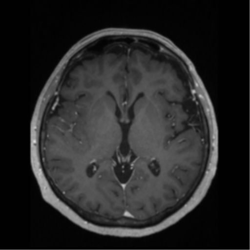 File:Anaplastic astrocytoma IDH wild-type (pseudoprogression) (Radiopaedia 42209-45276 Axial T1 C+ 78).png