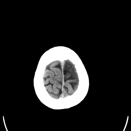 File:Anaplastic meningioma with recurrence (Radiopaedia 34452-35781 Axial non-contrast 31).png