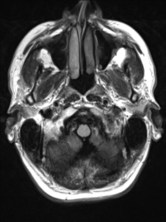 File:Anaplastic meningioma with recurrence (Radiopaedia 34452-35788 Axial T2 FLAIR 2).png