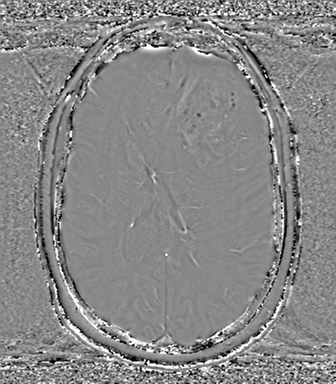 Anaplastic oligodendroglioma (Radiopaedia 83500-98599 Axial SWI - phase 50).png