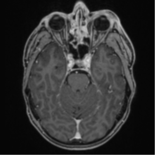 Anaplastic oligodendroglioma with skull fracture (Radiopaedia 74831-85845 Axial T1 C+ fat sat 19).png