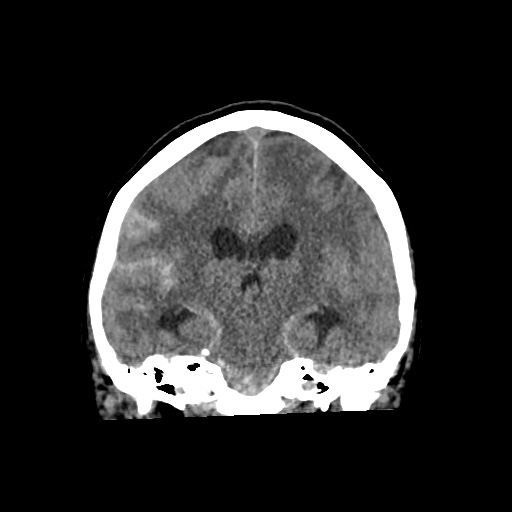 File:Aneursym related subarachnoid hemorrhage with hydrocephalus (Radiopaedia 45105-49083 Coronal non-contrast 36).jpg
