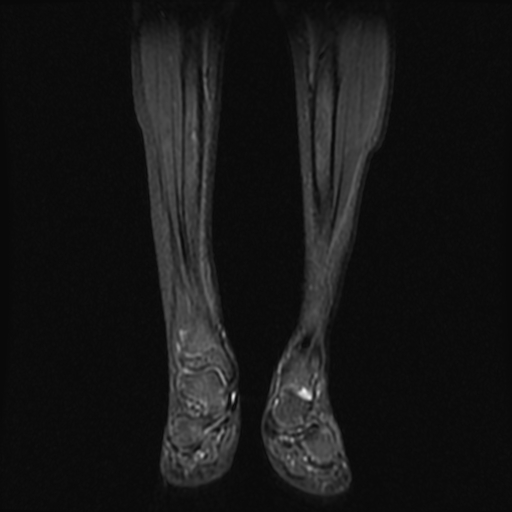 File:Aneurysmal bone cyst - tibia (Radiopaedia 22343-22367 Coronal STIR 6).jpg