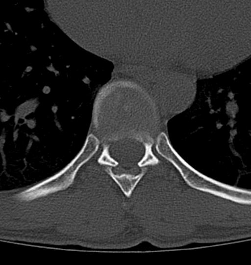 Aneurysmal bone cyst T11 (Radiopaedia 29294-29721 Axial bone window 19).jpg