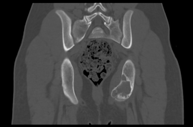 File:Aneurysmal bone cyst of ischium (Radiopaedia 25957-26094 Coronal bone window 30).png