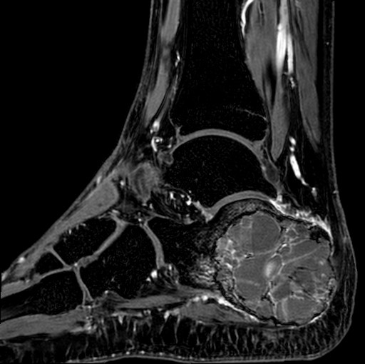File:Aneurysmal bone cyst of the calcaneus (Radiopaedia 60669-68420 F 23).jpg