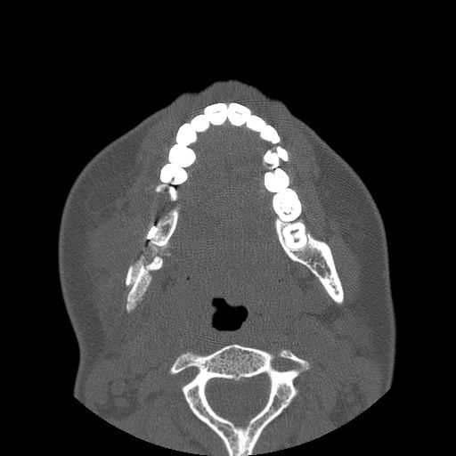 File:Aneurysmal bone cyst of the mandible (Radiopaedia 43280-46823 Axial bone window 62).jpg