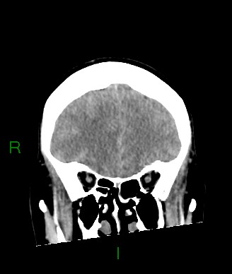 Aneurysmal subarachnoid hemorrhage with intra-axial extension (Radiopaedia 84371-99699 Coronal non-contrast 50).jpg