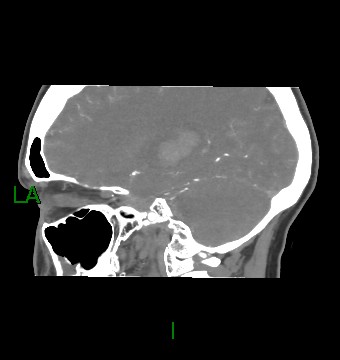 Aneurysmal subarachnoid hemorrhage with intra-axial extension (Radiopaedia 84371-99732 B 43).jpg
