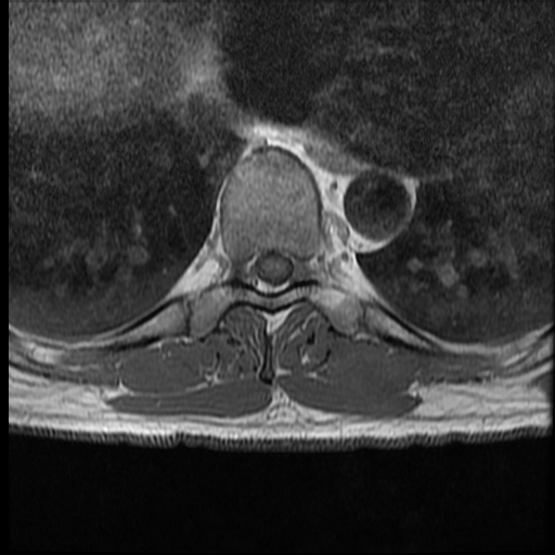 File:Angiolipoma - thoracic spine (Radiopaedia 28242-28479 Axial T1 1).jpg
