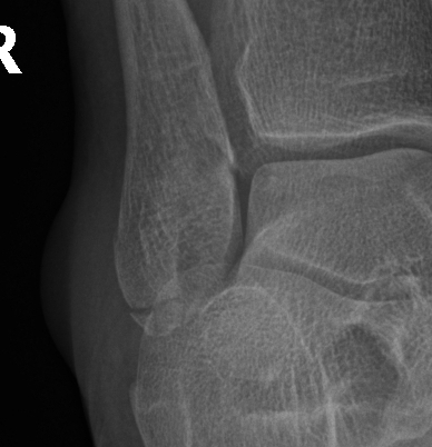 File:Ankle fracture - Weber A (Radiopaedia 9680-39499 Magnified view 1).jpg