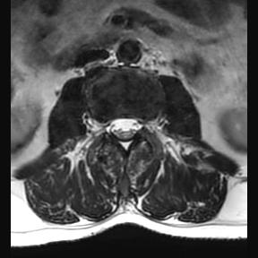 File:Ankylosing spondylitis with zygapophyseal arthritis (Radiopaedia 38433-40516 Axial T2 13).jpg
