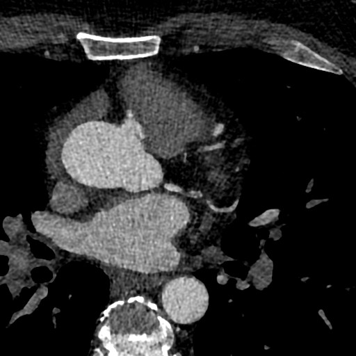 File:Anomalous origin of the left coronary artery with malignant course (Radiopaedia 77842-90126 C 42).jpeg