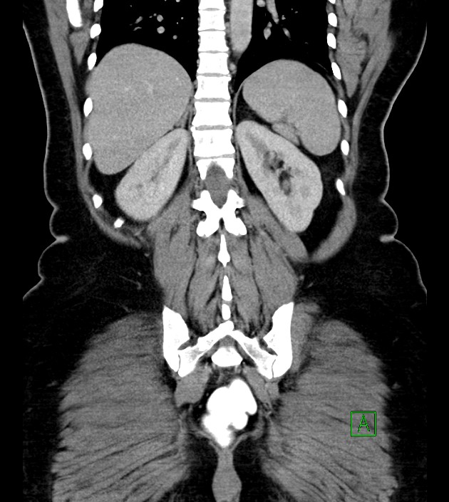 Anterior abdominal wall CSF pseudocyst (CSFoma) (Radiopaedia 79453-92571 B 42).jpg