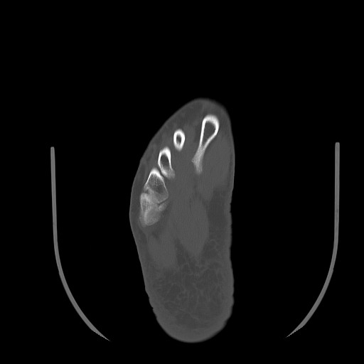 Anterior calcaneal process fracture (Radiopaedia 82590-96762 Axial bone window 34).jpg