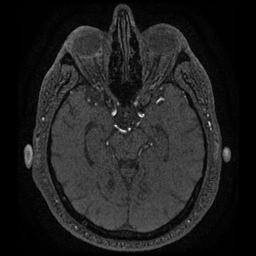 Anterior cerebral artery infarction (Radiopaedia 46794-51323 Axial MRA 78).jpg