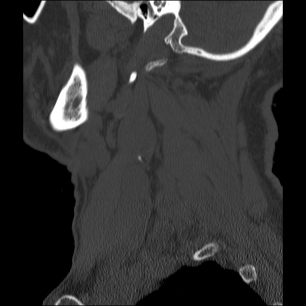 Anterior cervical postdiscectomy arthrodesis (Radiopaedia 32678-33646 Sagittal bone window 1).jpg