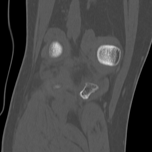 File:Anterior cruciate ligament avulsion fracture (Radiopaedia 58939-66194 Coronal bone window 28).jpg