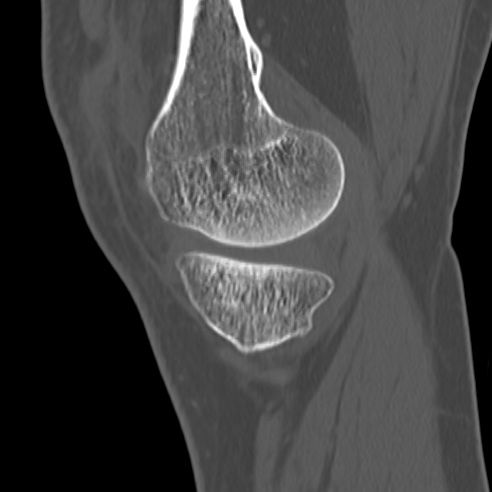 File:Anterior cruciate ligament avulsion fracture (Radiopaedia 58939-66194 Sagittal bone window 31).jpg