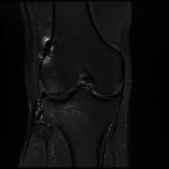 File:Anterior cruciate ligament graft tear and bucket-handle tear of medial meniscus (Radiopaedia 75867-87254 Coronal PD fat sat 14).jpg