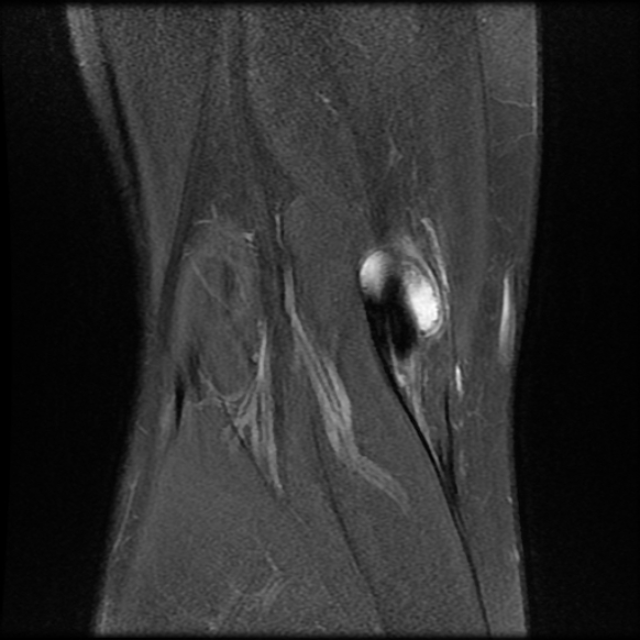 File:Anterior cruciate ligament graft tear and bucket-handle tear of medial meniscus (Radiopaedia 75867-87254 Coronal PD fat sat 22).jpg