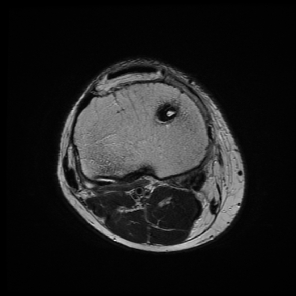 File:Anterior cruciate ligament graft tear and bucket-handle tear of medial meniscus (Radiopaedia 75867-87255 Axial T2 5).jpg