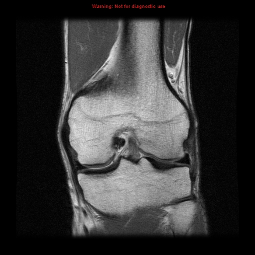 File:Anterior cruciate ligament injury - partial thickness tear (Radiopaedia 12176-12515 Coronal PD 11).jpg