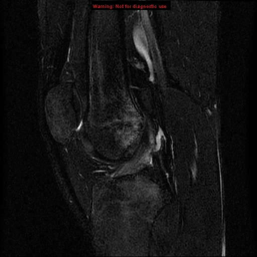File:Anterior cruciate ligament injury - partial thickness tear (Radiopaedia 12176-12515 Sagittal T2 fat sat 10).jpg