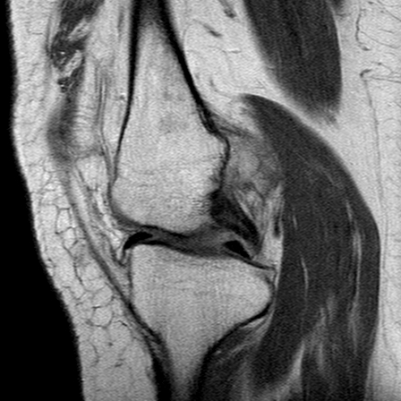 File:Anterior cruciate ligament mucoid degeneration (Radiopaedia 60853-68633 Sagittal PD 14).jpg