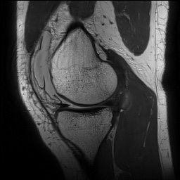 Anterior cruciate ligament rupture with Segond fracture (Radiopaedia 69043-78806 Sagittal PD 64).jpg