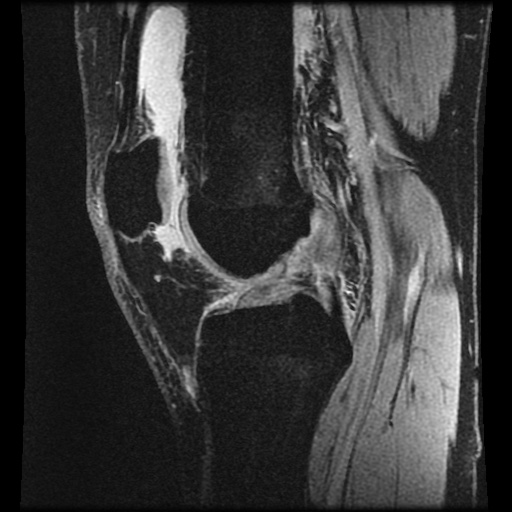 Anterior cruciate ligament tear (Radiopaedia 61500-69462 F 45).jpg