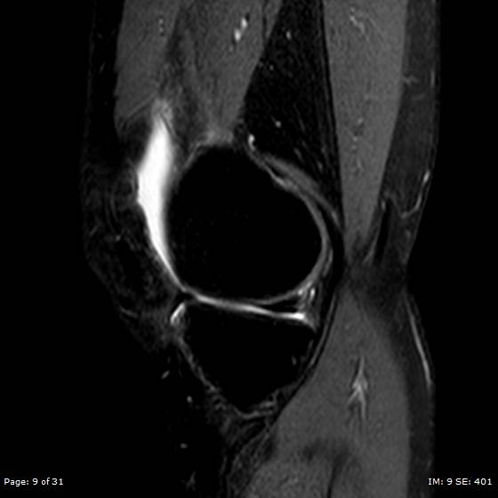 File:Anterior cruciate ligament tear (Radiopaedia 70783-80964 Sagittal STIR 9).jpg
