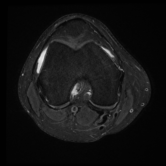 File:Anterior cruciate ligament tear with posteromedial corner injury, bucket-handle meniscal tear and chondral delamination (Radiopaedia 75501-86744 Axial PD fat sat 15).jpg