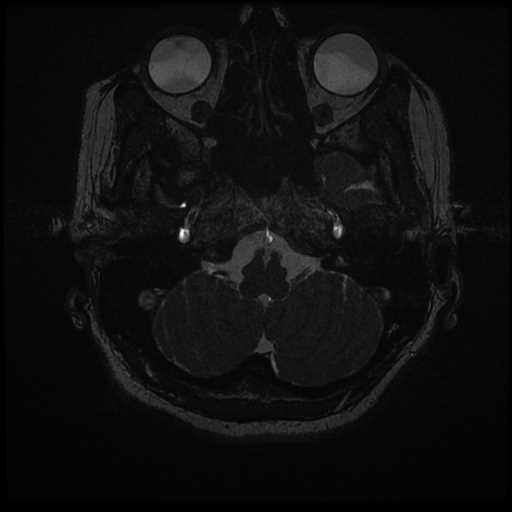 Anterior inferior cerebellar artery vascular loop - type II (Radiopaedia 70991-81209 Axial 3D FIESTA 65).jpg