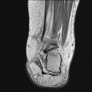 File:Anterior talofibular ligament injury - rupture with soft-tissue impingement (Radiopaedia 38765-40928 Coronal PD 10).jpg