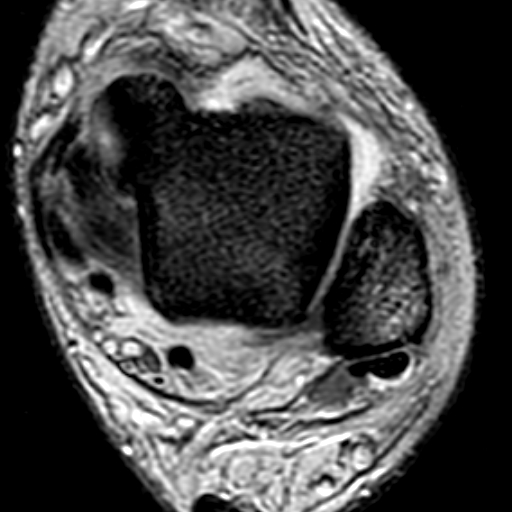 File:Anterior talofibular ligament rupture (Radiopaedia 15831-15484 Axial T2* 9).jpg