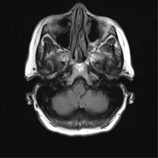 File:Anterior temporal pole cysts (Radiopaedia 46629-51102 Axial FLAIR 4).png