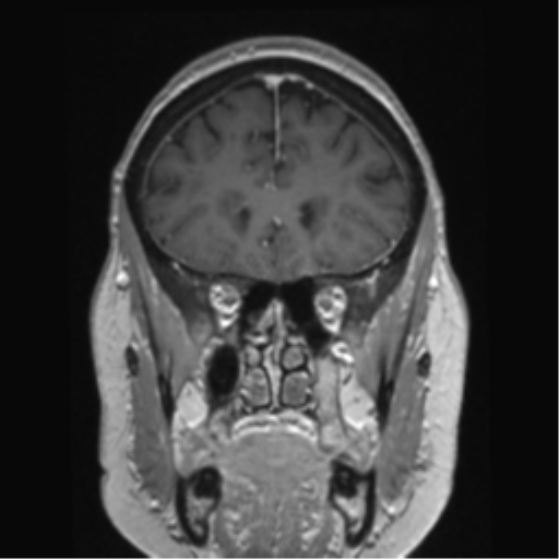 Anterior temporal pole cysts (Radiopaedia 46629-51102 Coronal T1 C+ 126).png