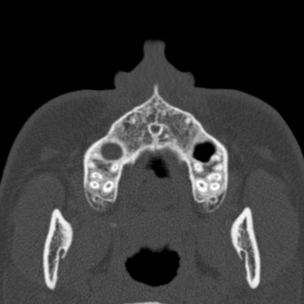 Antrochoanal polyp (Radiopaedia 33984-35202 Axial bone window 4).jpg