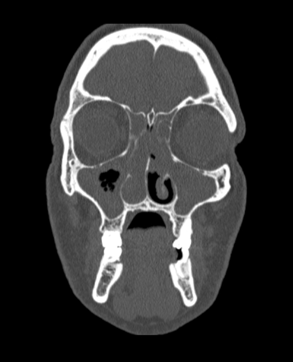 Antrochoanal polyp (Radiopaedia 79011-92169 Coronal bone window 59).jpg