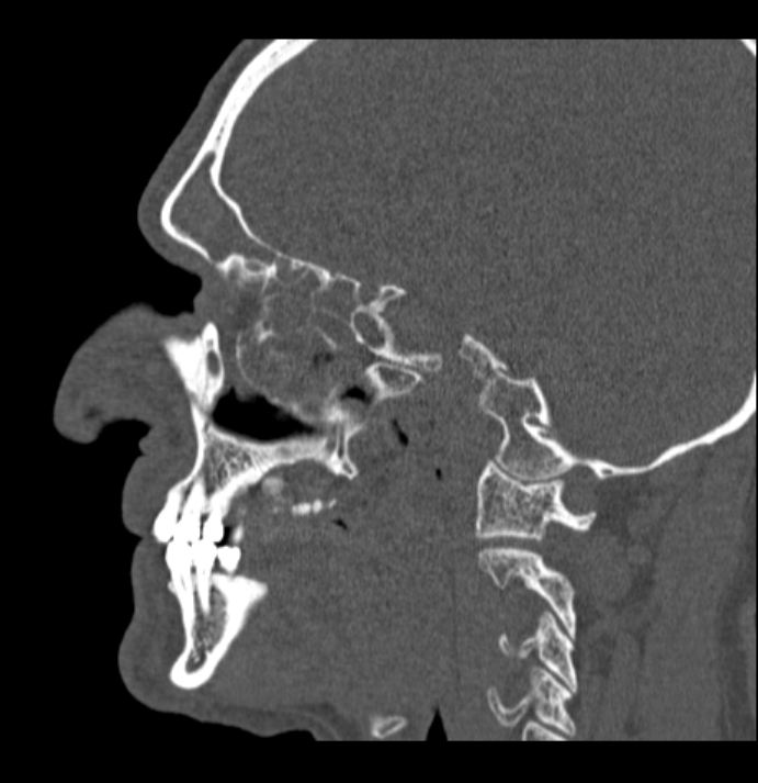 Antrochoanal polyp (Radiopaedia 79011-92169 Sagittal bone window 46).jpg