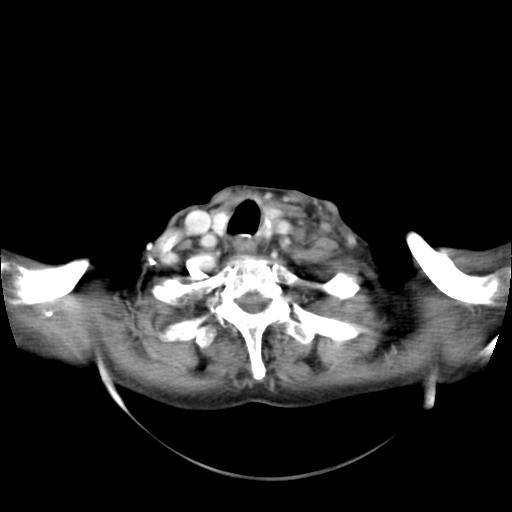 File:Aortic arch aneurysm (Radiopaedia 25313).jpg