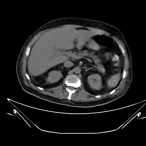File:Aortic arch aneurysm (Radiopaedia 84109-99365 Axial non-contrast 296).jpg