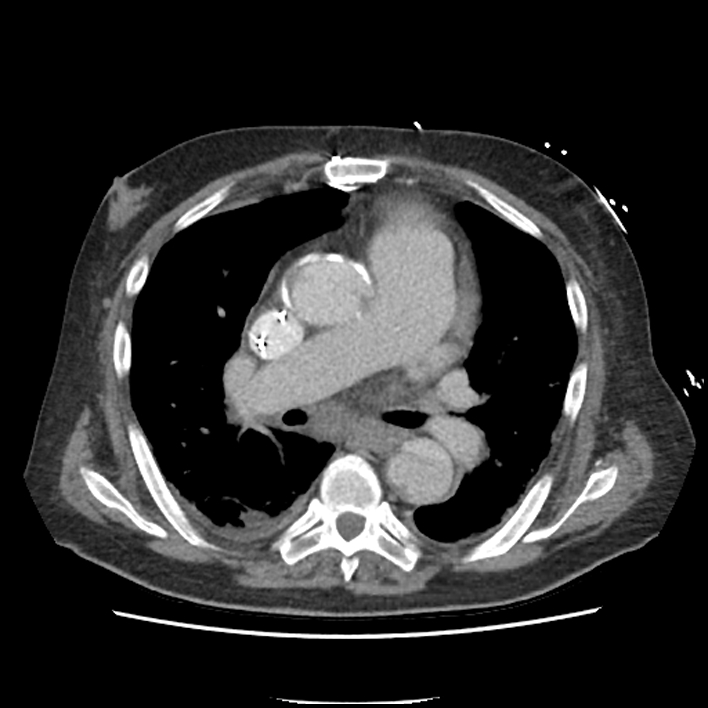 Aortic arch graft infection (FDG PET-CT) (Radiopaedia 71975-82437 A 26).jpg