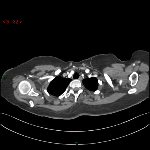 Aortic arch origin of left vertebral artery (Radiopaedia 51520-57286 A 31).jpg