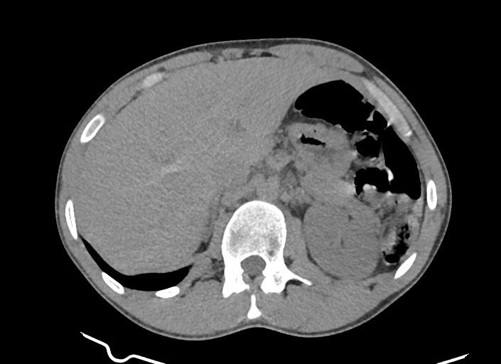 File:Aortic coarctation with aneurysm (Radiopaedia 74818-85828 A 25).jpg