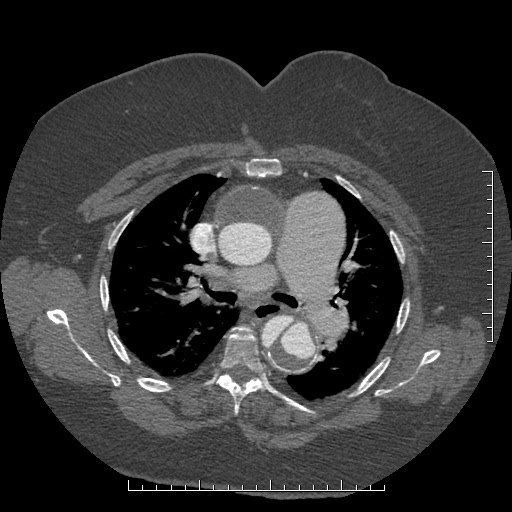 File:Aortic dissection- Stanford A (Radiopaedia 35729-37268 A 32).jpg