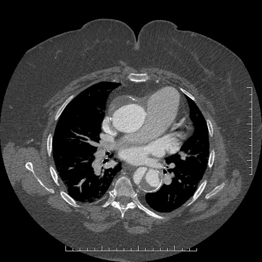 File:Aortic dissection- Stanford A (Radiopaedia 35729-37268 A 45).jpg